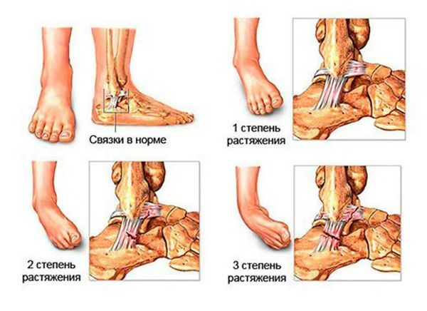 jala liigeste vigastused artriidi vees liigestes