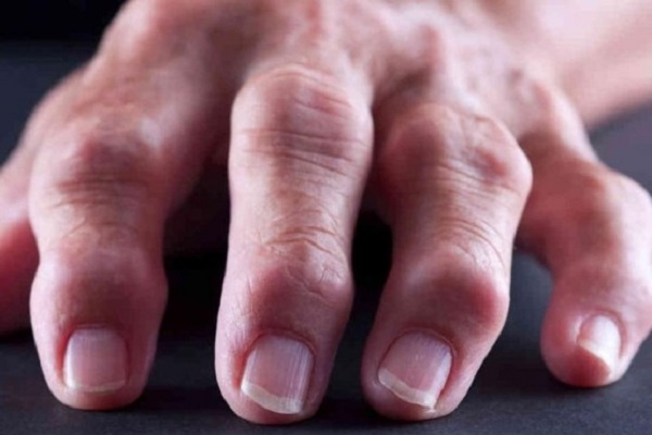 kuidas artriit avaldub sormedel