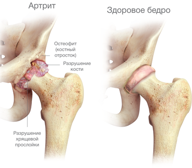 artrosi ravimine brachiaalsete uhiste ulevaatuste kiire geeli ulevaated osteokondroosis