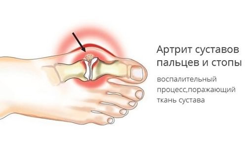 arc-sunnitud liigeste artroosi ravi selleks et mitte kiirustada sormede liigeseid