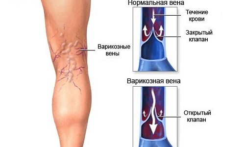 arthroosi jalgade ravi kodus auverdi liigeste ravi