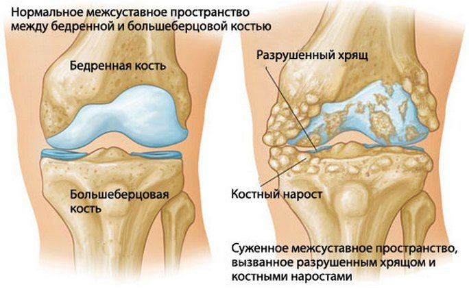 liigeste haiguste artriidi ja artroosi jareldus