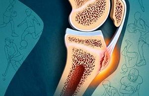 osteokondroos ja artroos