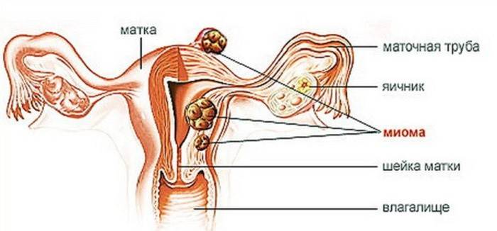 endometrioosi valu liigestes meetodite loomine artroosi jaoks