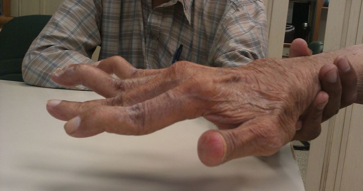 keskmine sormehaigus hurt harjade sormed