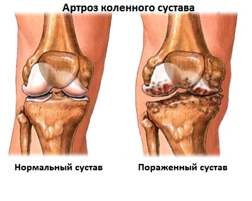 haiget jalgade harjatele liigeste kaasaegne ravi