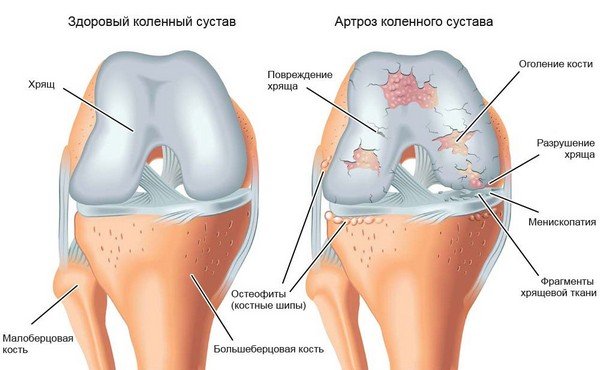artrosi jalgade raviks