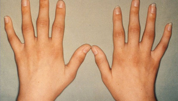 varajane artriit sorme liigeste