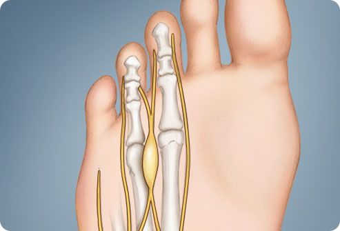 mazi-d sormeotste ravi liigeste raviks inimeste meetodid artriidi sormede raviks