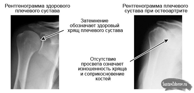 mida teha sormega liigese artriidiga murminatsioon parast venitamist